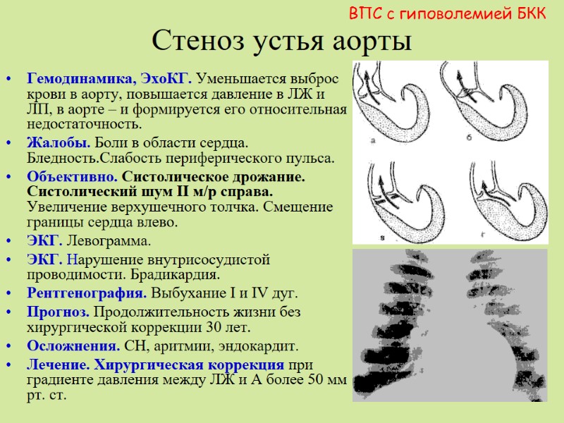 Стеноз устья аорты Гемодинамика, ЭхоКГ. Уменьшается выброс крови в аорту, повышается давление в ЛЖ